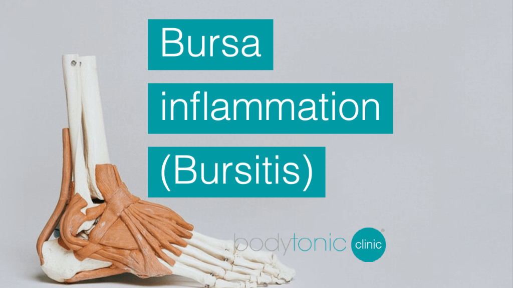 Bursa inflammation Bursitis london bodytonic clinic