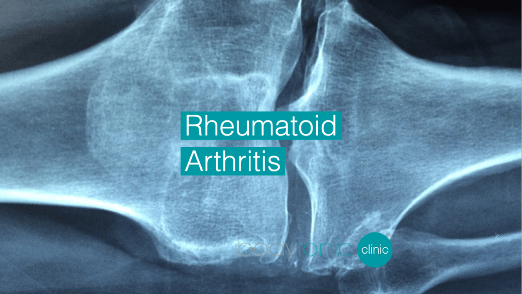 Rheumatoid Arthritis bodytonic clinic London