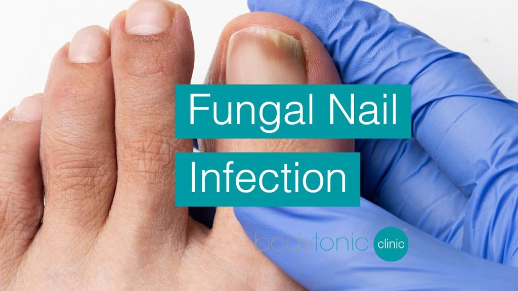 Fungal Nail Infection bodytonic clinic SE16 London E15 E14