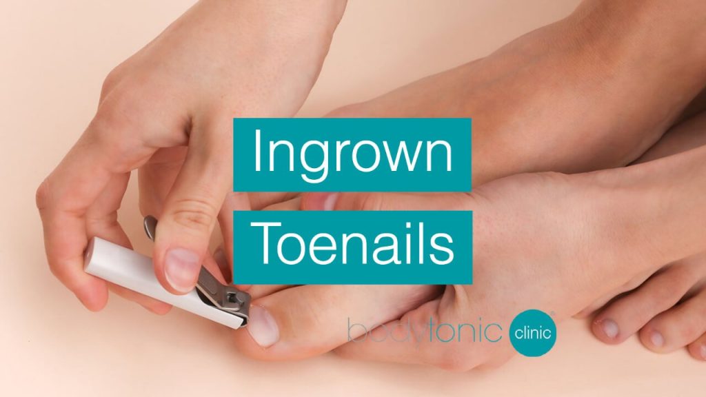 Ingrown toenails bodytonic clinic SE16 London E15 E14