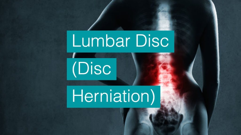 Lumbar Disc (Disc Herniation) bodytonic clinic SE16 London E15 E14