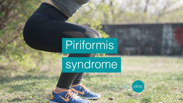 piriformis syndrome