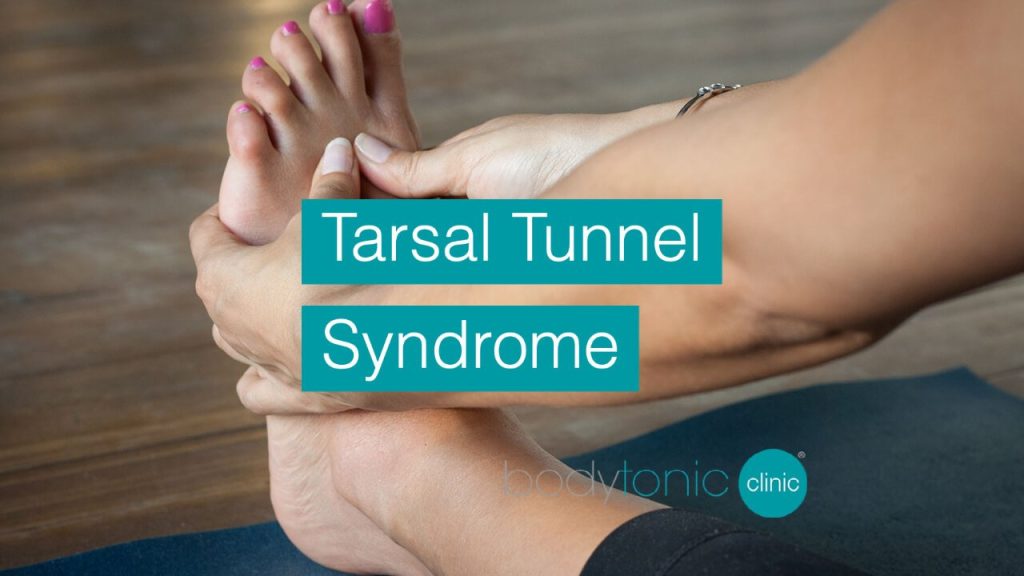 Tarsal Tunnel Syndrome bodytonic clinic SE16