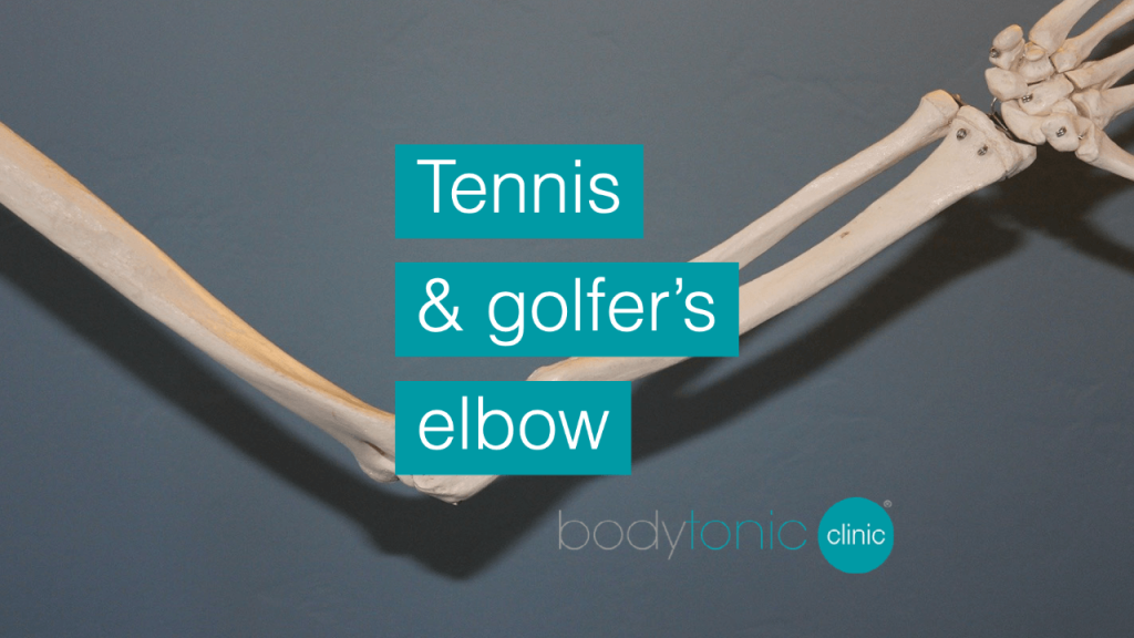 Tennis and Golfers Elbow bodytonic clinic SE16 London