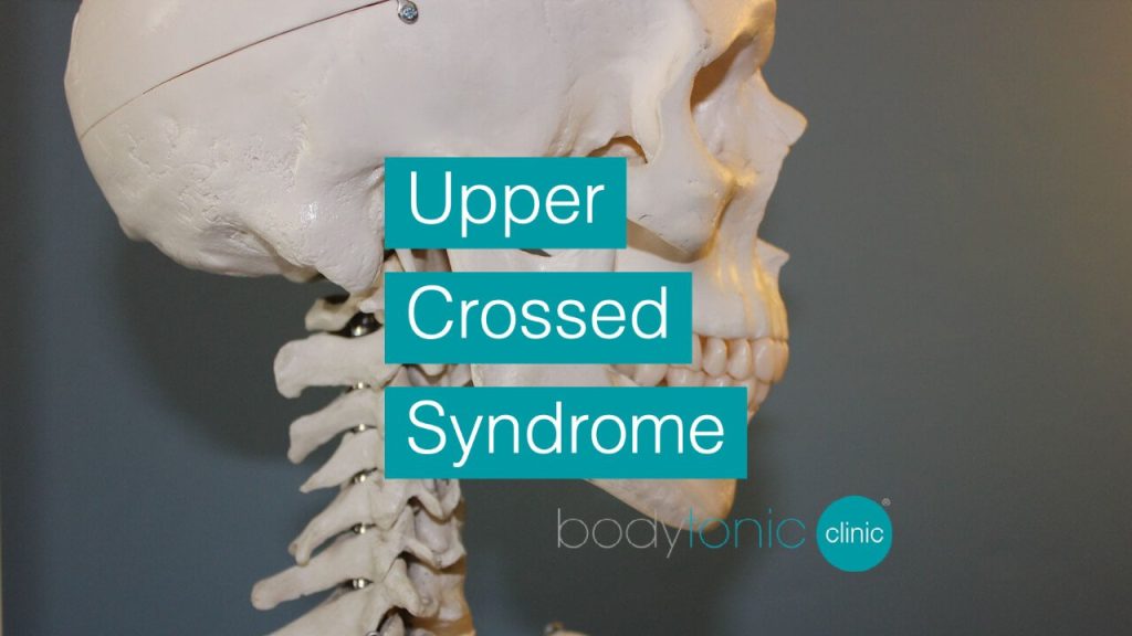 Upper Crossed Syndrome bodytonic clinic SE16 London