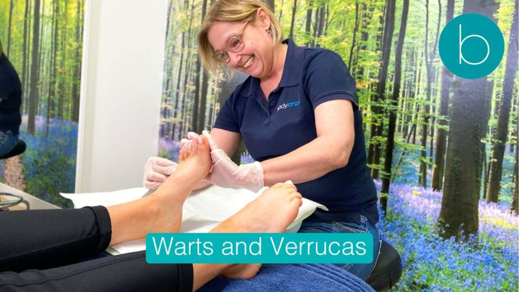 Clinical diagnosis of a plantar verruca on a patient's foot at Bodytonic Clinic London, showing disrupted skin ridges.