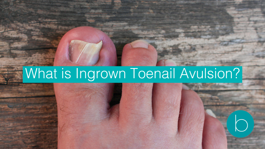 Close-up of a foot with an ingrown toenail against a wooden background, with overlaid text that reads 'What is Ingrown Toenail Avulsion?' and a teal logo in the corner.